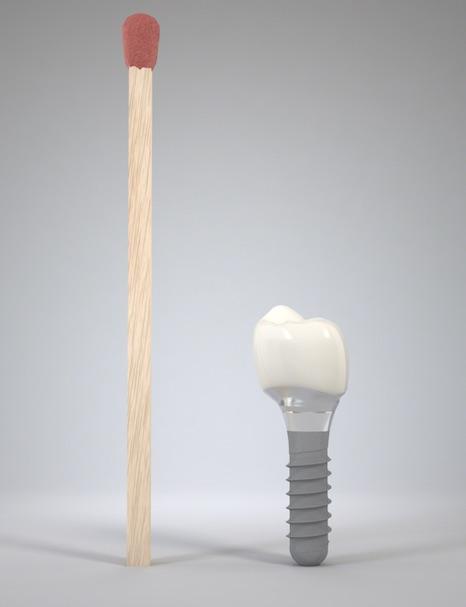 Implant dentaire à coté d'une alumette
